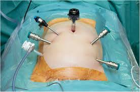 Robotic Vesicovaginal Fistula Repair