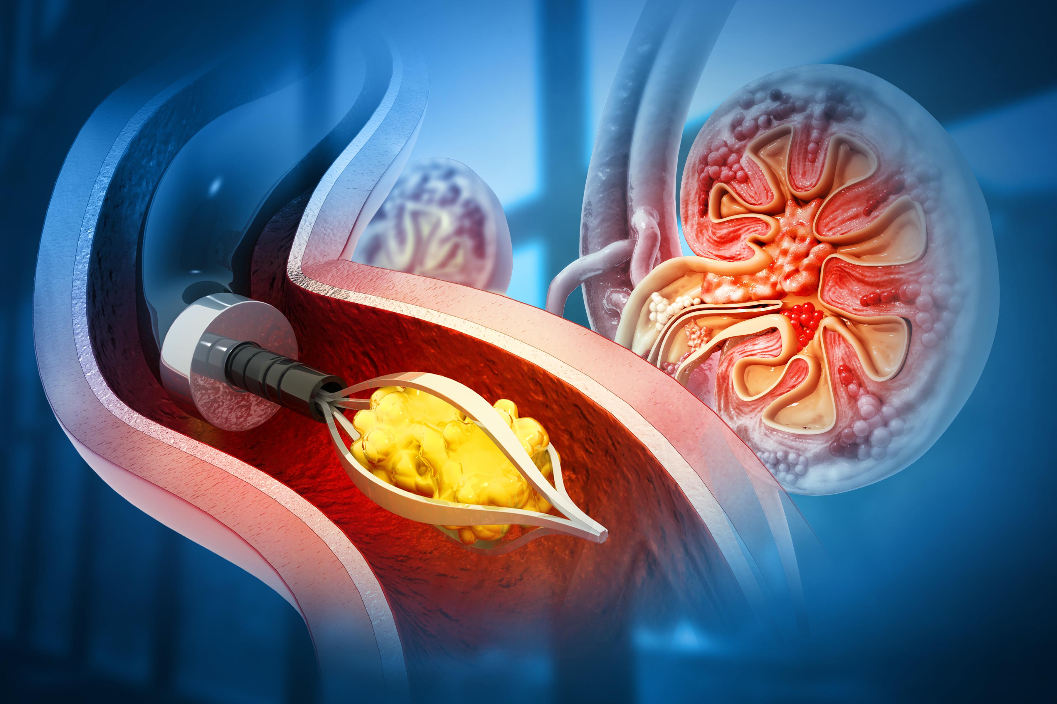 Kidney Stones Treatment and RIRS