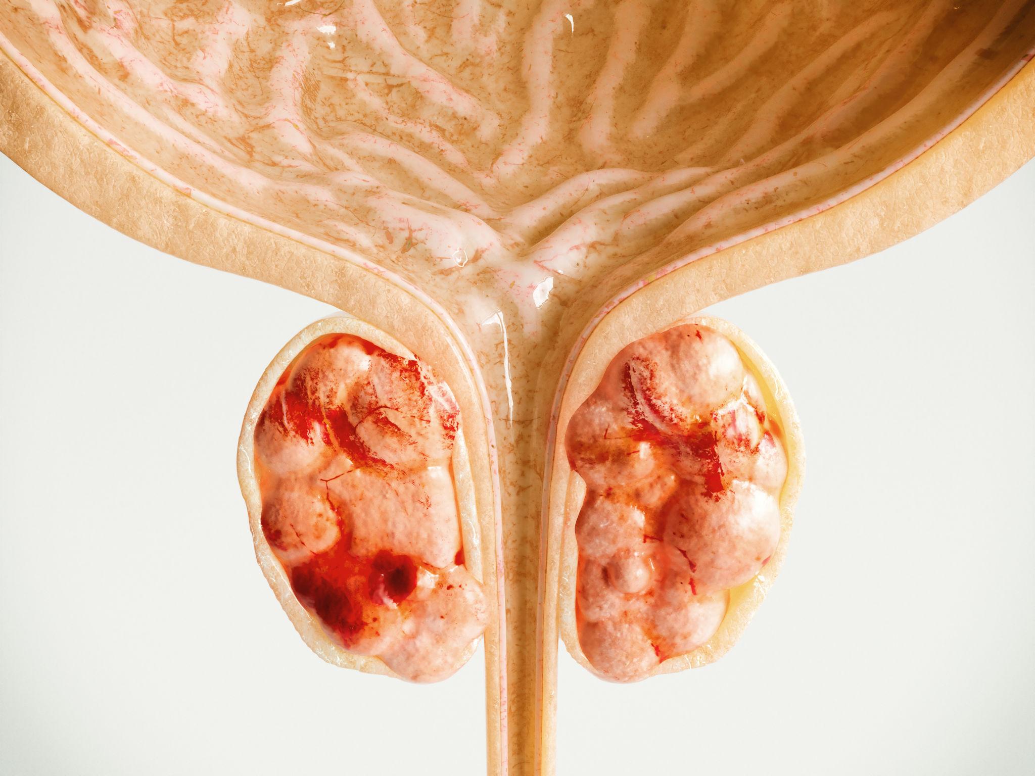 Prostate Cancer Care