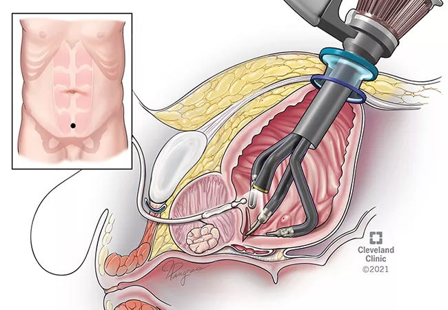 Robotic Prostatectomy Surgery