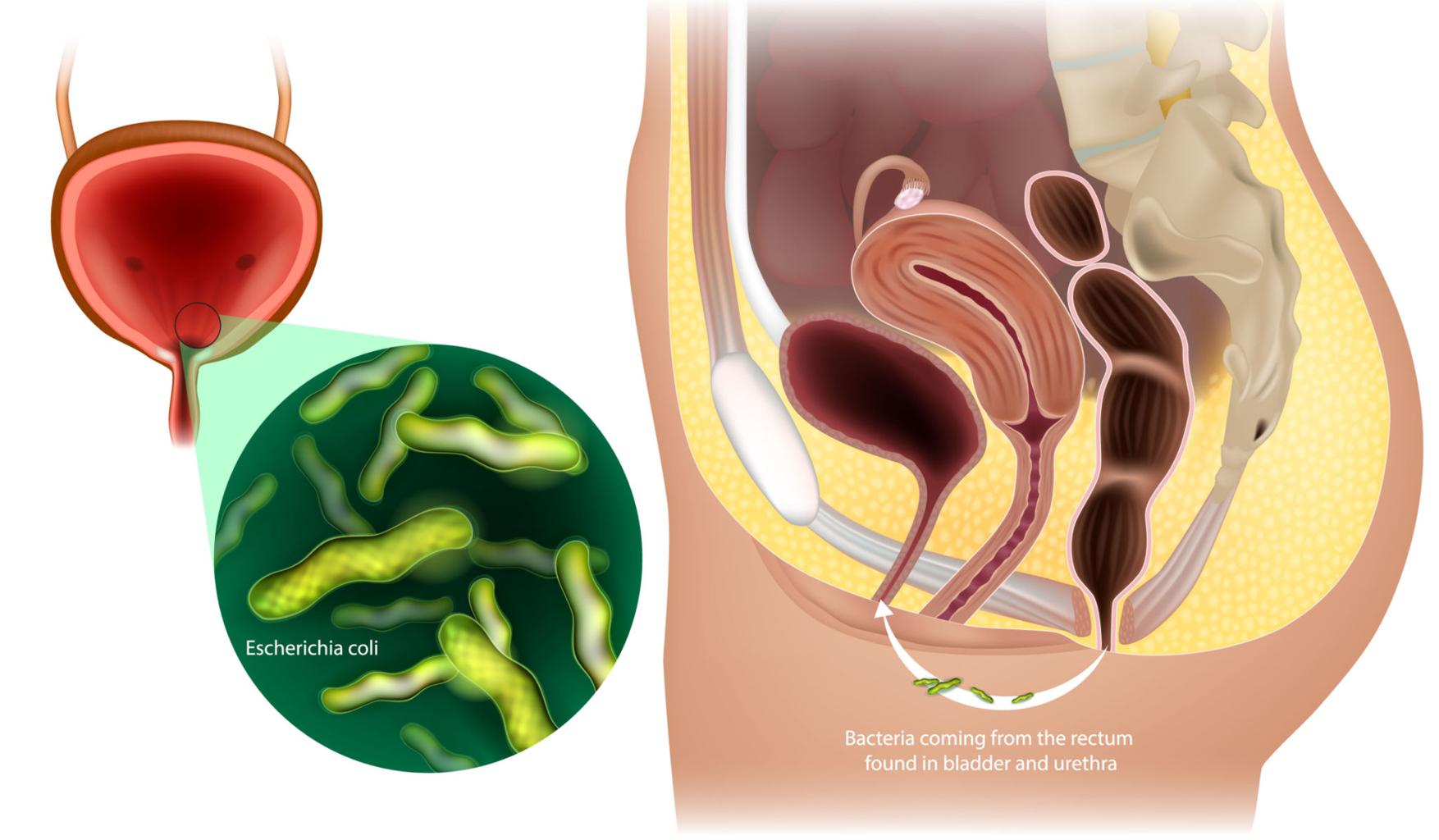 Urinary Tract Infection Care